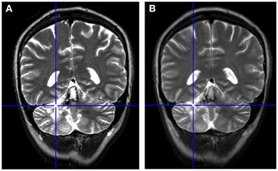 Evidence of Cerebellar Involvement in the Onset of a Manic State